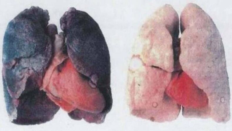 Many chronic alcoholics die due to lung damage (left)