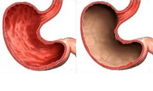 Ulcers, gastritis, cancer and other pathologies of the stomach (right), the occurrence of which was caused by alcohol